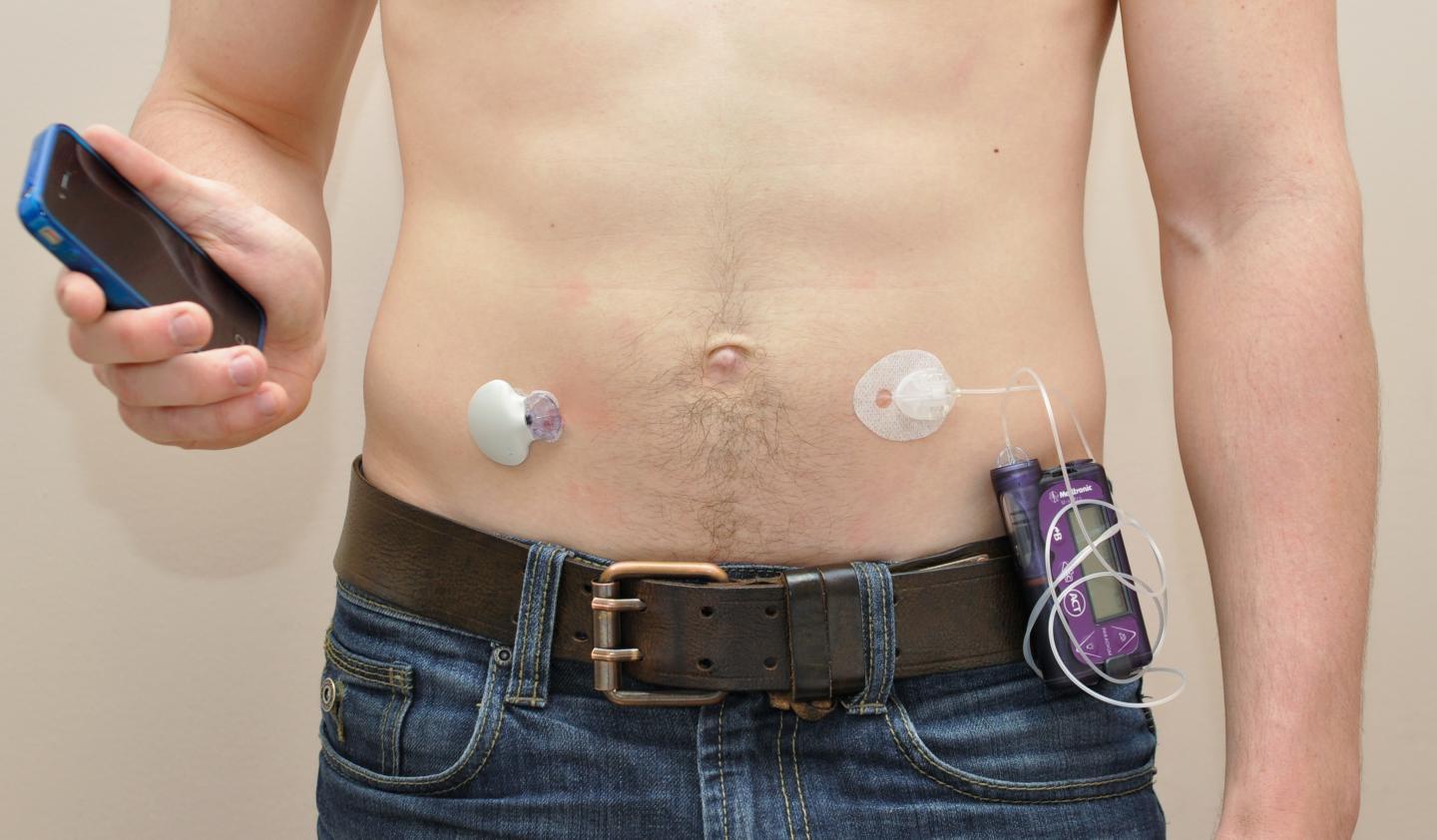 The artificial pancreas shown to improve the treatment of type 1 ...