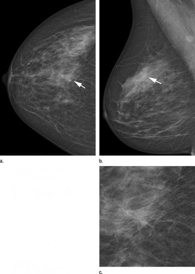 Novel technique increases detection rate in screening mammography ...